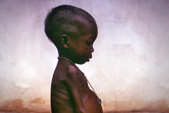 Une jeune fille souffrant de kwashiorkor, maladie causée par la malnutrition.