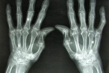 Radiographie des mains des patients rhumatoïdes.