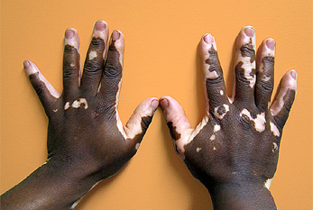 Deux mains d'une personne qui a le vitiligo.