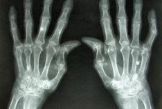 Journée mondiale du rhumatisme 2027