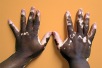 Journée mondiale du vitiligo 2023